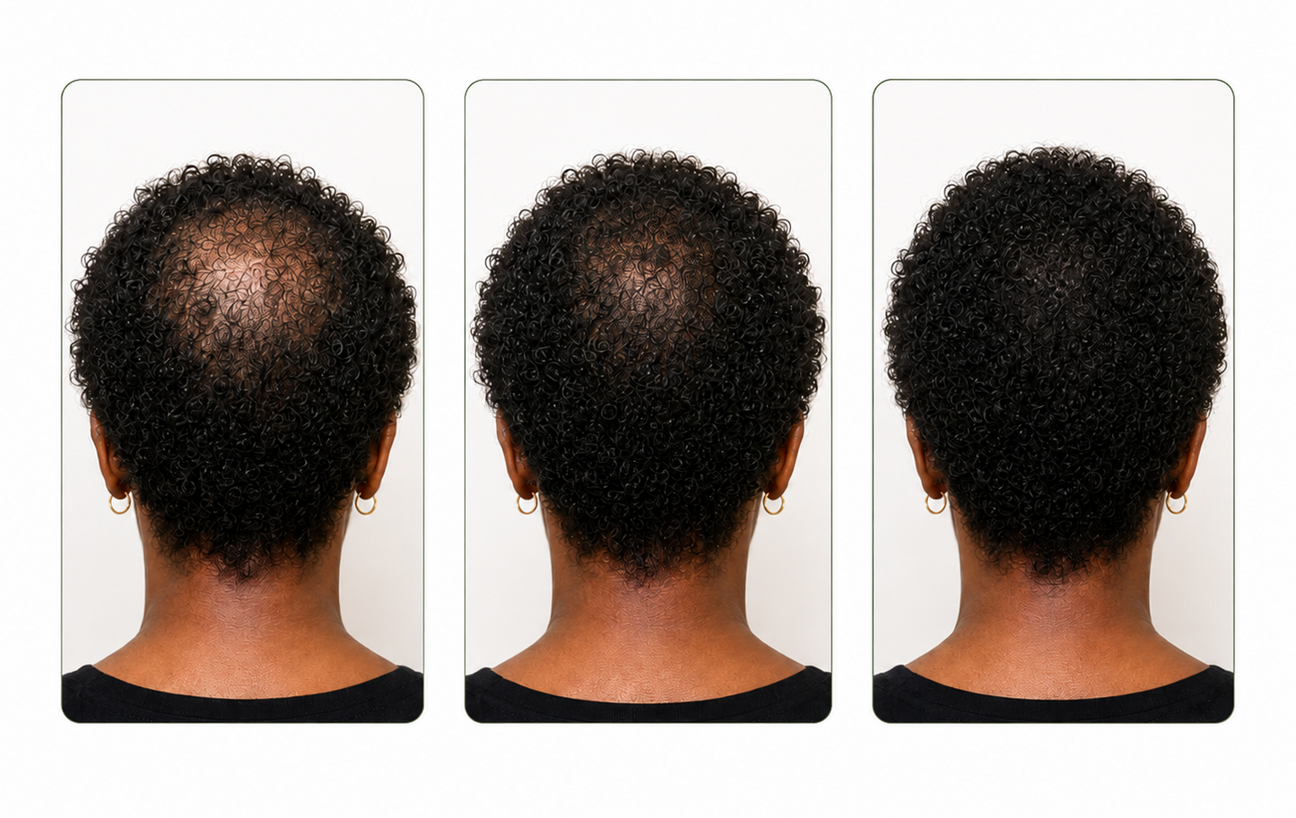 Three side-by-side back view photos of a person with short curly dark hair, showing progressively fuller hair density under the text 'REAL RESULTS' on a white background.